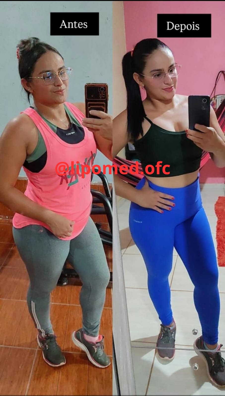 Antes e depois de cliente após uso do LipoMed